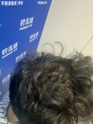-碧莲盛不剃发植发