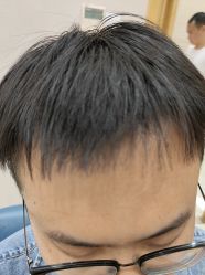 点击看大图 体验后-大麦微针植发丨全国连锁