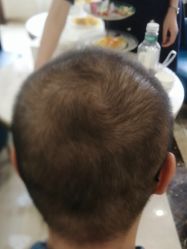 -碧莲盛·不剃发植发