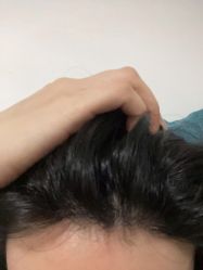 点击看大图 -大麦微针植发丨全国连锁