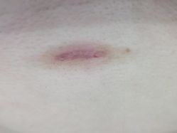 -成都军建医院·疤痕诊疗中心