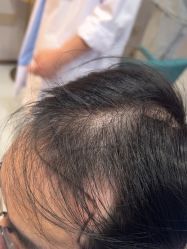 -碧莲盛不剃发植发