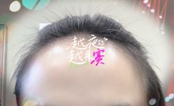 -大麦微针植发全国连锁