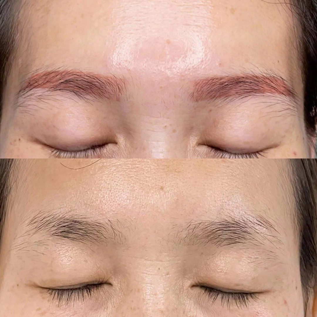 无创洗眉 pk 传统激光洗眉
传统洗眉