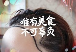 -大麦微针植发全国连锁