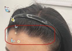 -大麦微针植发全国连锁