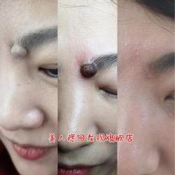 -美人痣全国连锁