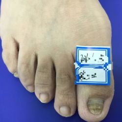 -德哥灰指甲脚气甲沟炎跖疣护理
