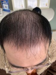 -大麦微针植发丨全国连锁