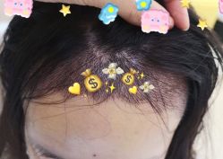 -大麦微针植发全国连锁