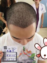 点击看大图 -大麦微针植发丨全国连锁