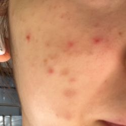 体验前-新雨池不针清祛痘