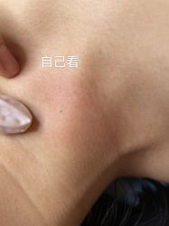 -爱莎扁平疣·汗管瘤·斑痣中心