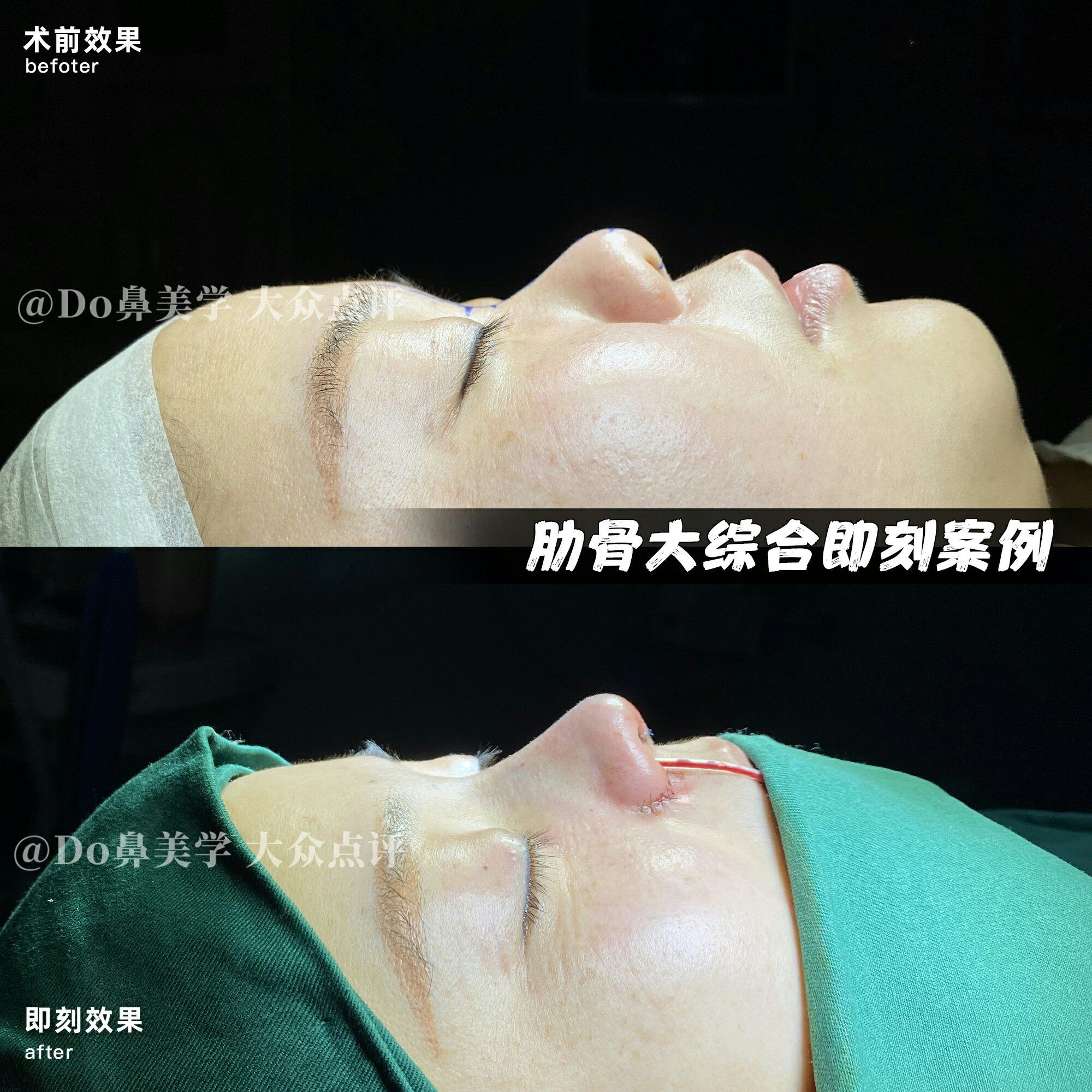 蒜头鼻改善即刻效果对比