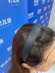 -碧莲盛不剃发植发