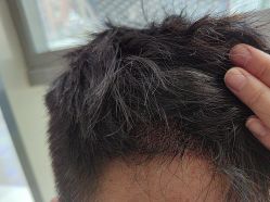 -碧莲盛·不剃发植发