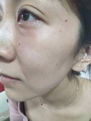 -北京美痣堂古方祛痣斑疣瘊