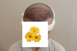 -大麦微针植发丨全国连锁