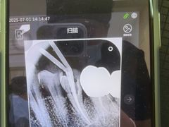 -上海仁爱医院口腔科 · 种植