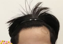 -大麦微针植发全国连锁