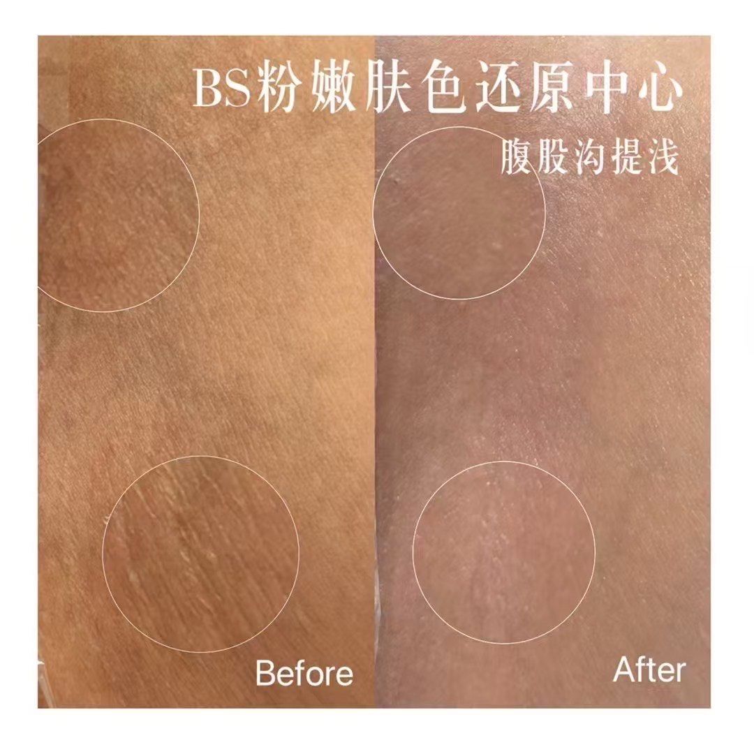 腹股沟色素提浅