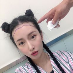 -碧莲盛·不剃发植发