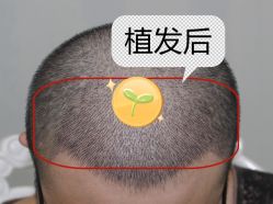 -大麦微针植发全国连锁