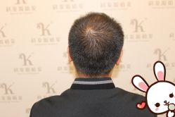 点击看大图 -大麦微针植发丨全国连锁