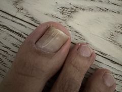 -祖传修脚甲沟炎灰指甲鸡眼