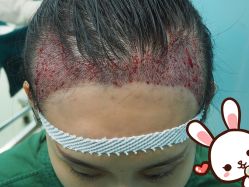 点击看大图 -大麦微针植发丨全国连锁