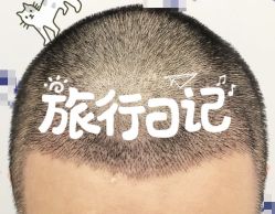 -大麦微针植发全国连锁