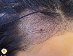 -大麦微针植发丨全国连锁