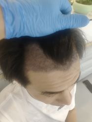 -大麦微针植发丨全国连锁