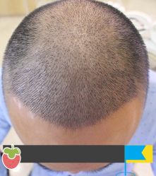 -大麦微针植发丨全国连锁