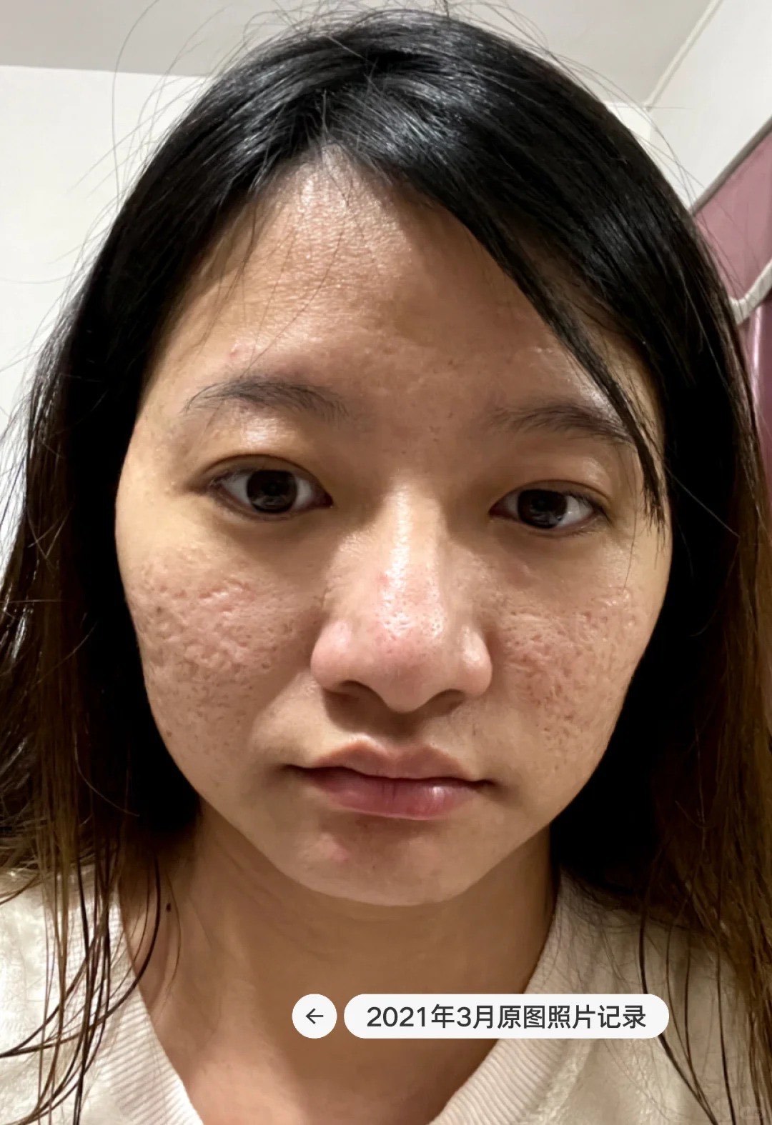 痘坑治疗(懒人版)