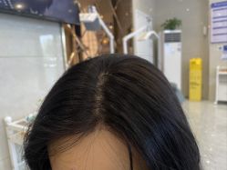 -碧莲盛·不剃发植发