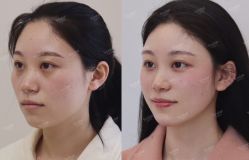 点击看大图 体验后-Yestar宁波艺星整形医院