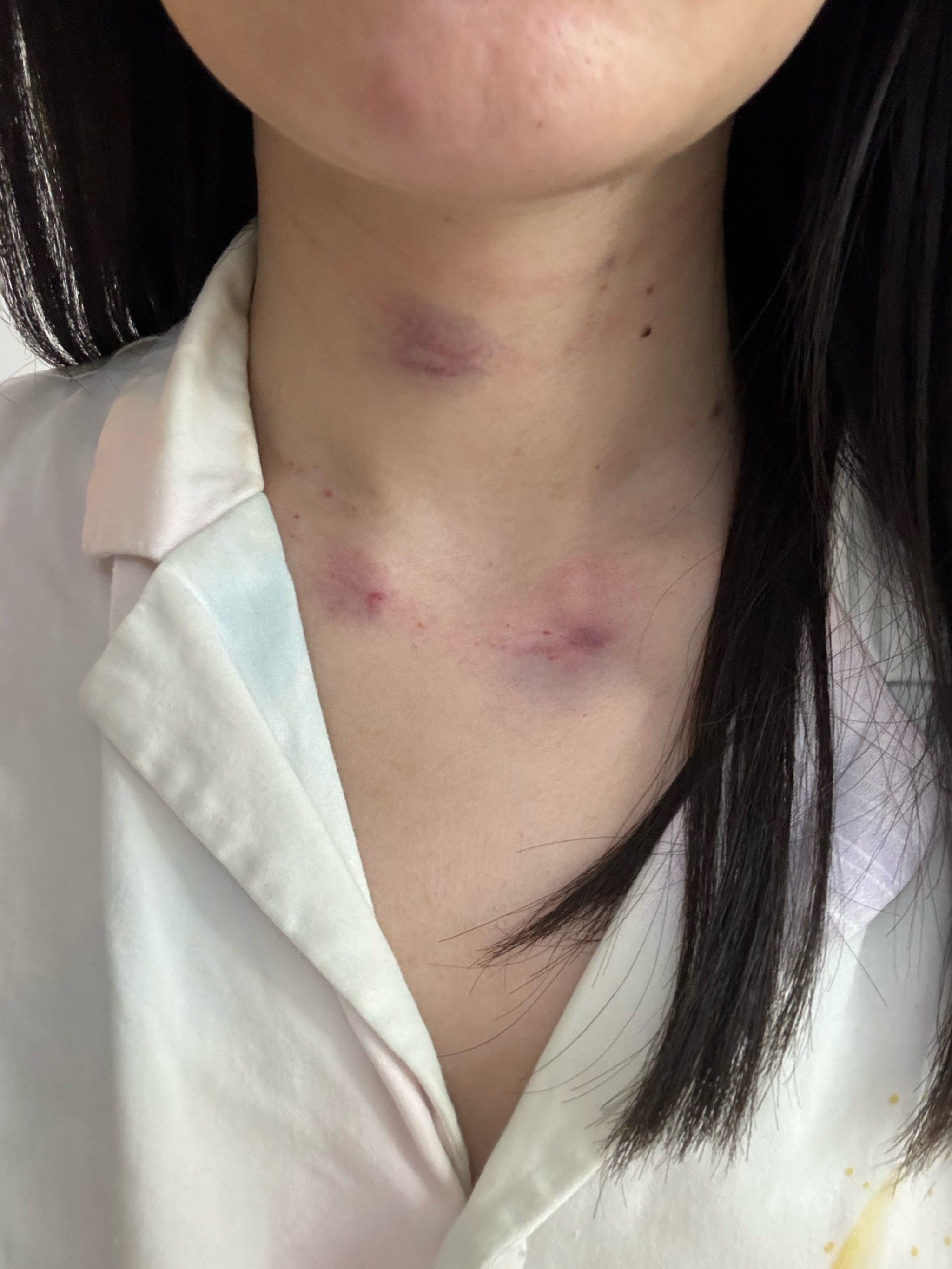 打颈纹变成这样,正常吗?