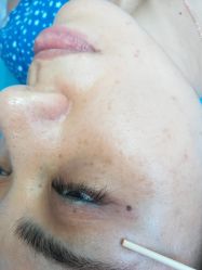 -美丽人生祛斑扁平疣汗管瘤中心