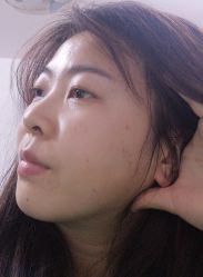 -美丽人生祛斑扁平疣汗管瘤中心