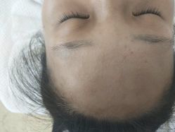 -苗方清颜专业祛痘