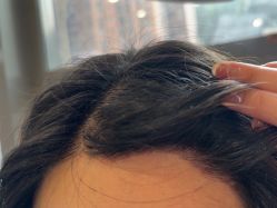 -碧莲盛·不剃发植发