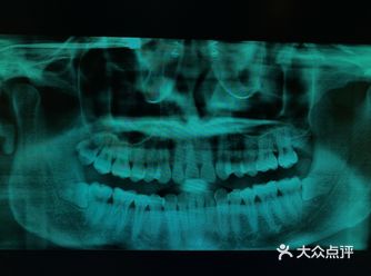 上周外院转诊来的#拔牙# 病人 左右智齿突发冠周炎需