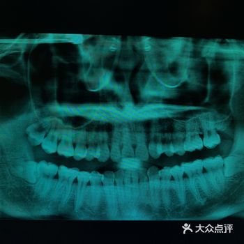 上周外院转诊来的#拔牙# 病人 左右智齿突发冠周炎需