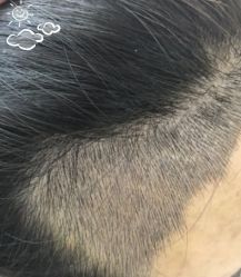 -大麦微针植发丨全国连锁