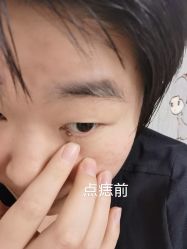 体验前-北京美痣堂古方祛痣斑疣瘊