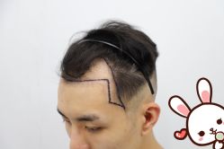 -大麦微针植发丨全国连锁