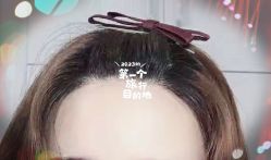 -大麦微针植发全国连锁