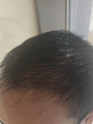 -碧莲盛·不剃发植发