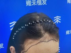 -雍禾植发全国连锁